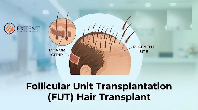 Follicular Unit Transplantation (FUT) Hair Transplant Method