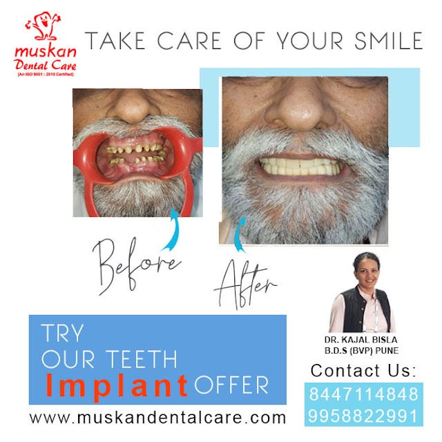 Affordable Dental Implants in Delhi NCR Your Solution for a Confident