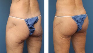 Butt Implants: Types, Risks, Costs, and Pictures, by Plastic Surgery