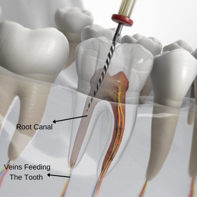 Root Canal Treatment Explained. Root canal treatment is a common dental