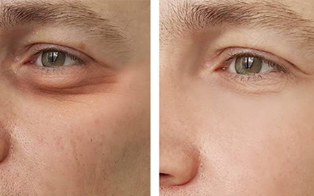 Blepharoplasty for Men: Why Eyelid Surgery Isn’t Just for Women