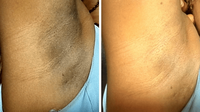 ✅ Como Clarear as Axilas: Guia Completo Passo a Passo para Eliminar Manchas Escuras