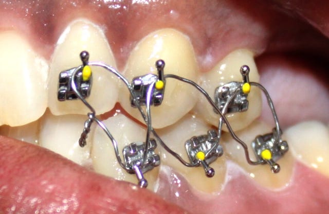 Why Your Orthodontist Changes Your Braces Wires - MEYARN Oral Care