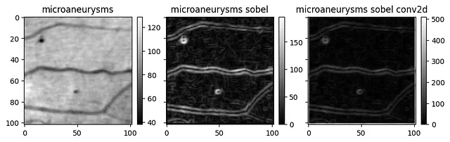 Figura 5. Dataset di “Microaneurysms” prima (sinistra) e dopo (centro e destra) l'applicazione del filtro di Sobel utilizzando entrambe le versioni. Credito: lavoro proprio.