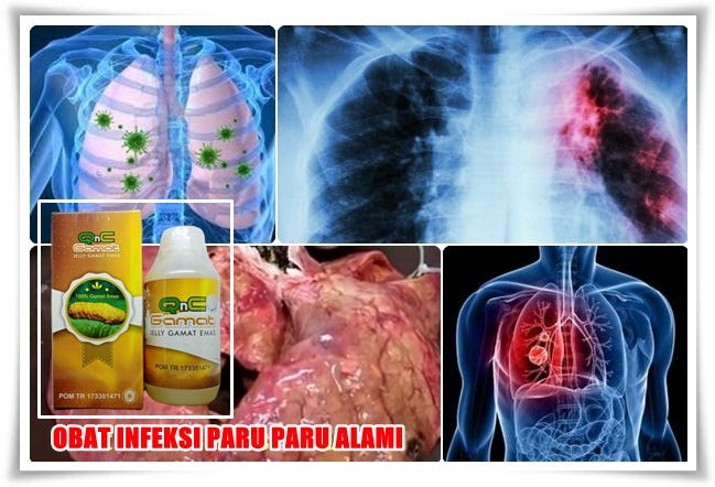 Obat Infeksi Paru Paru Tradisional 100% Alami Dan Efektif