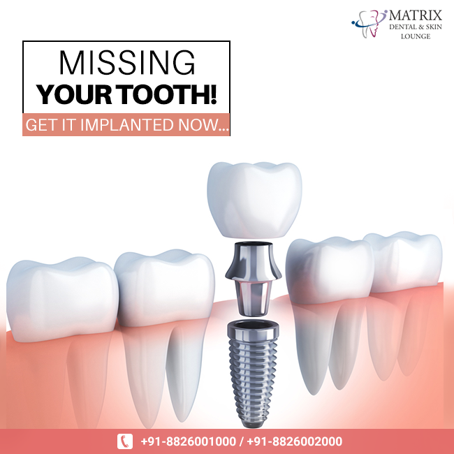 Why you should choose Dental Implants and who can provide Best Dental