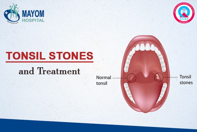 Tonsil Stones And Treatment Ent Specialist In Gurgaon By Rohan