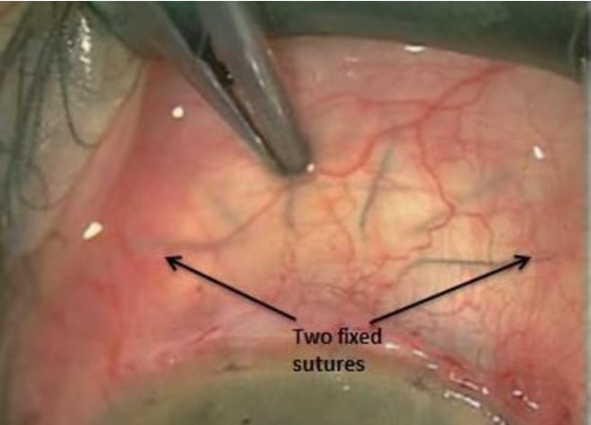Suture Management After Trabeculectomy: Why Timing Still Sparks Debate