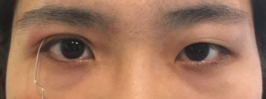 後悔沒早點做的醫美 × 新彩整形外科診所 ♥ 縫雙眼皮六年經