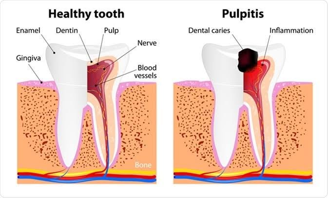 What is Pulpitis ?