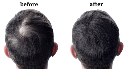 Regain Your Confidence and Look Younger with Hair Transplant Surgery