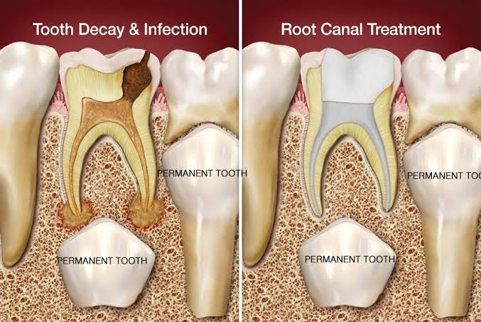 Exploring Root Canal Treatment in Petlad: A Comprehensive Guide and ...