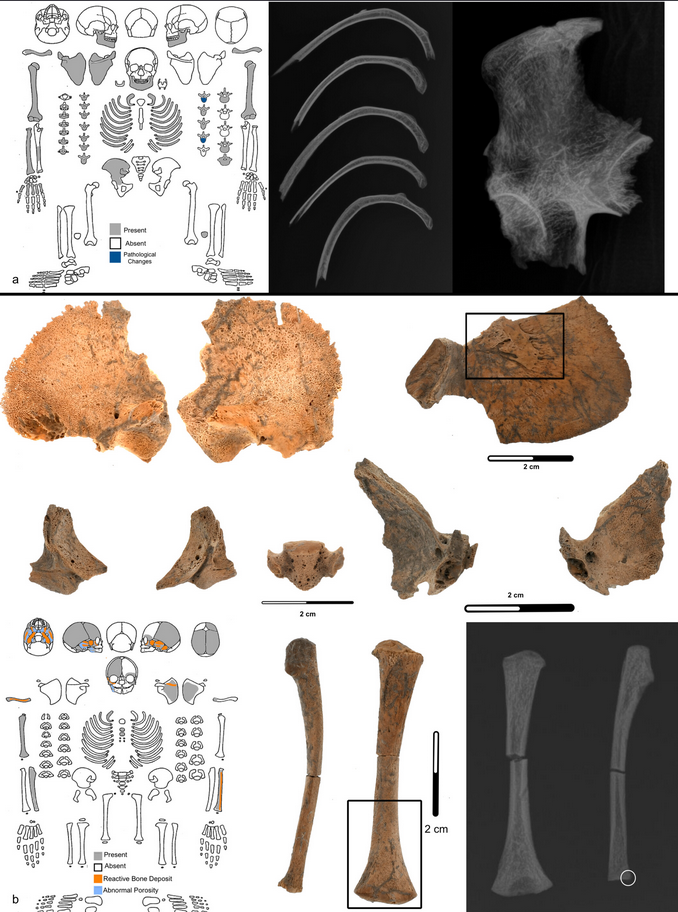 The first double burial from CA-ALA-11: an adult female (ALA-B26) showing pathological changes to her ribs and pelvis, and an infant (ALA-B27) with signs of scurvy. Credit: Caine et al. 2026.