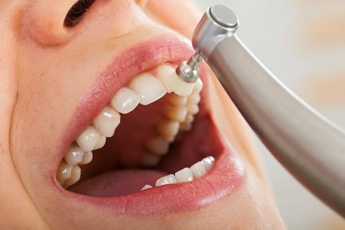 Dental Cleanings in Brampton: Keep Your Smile Healthy Year-Round