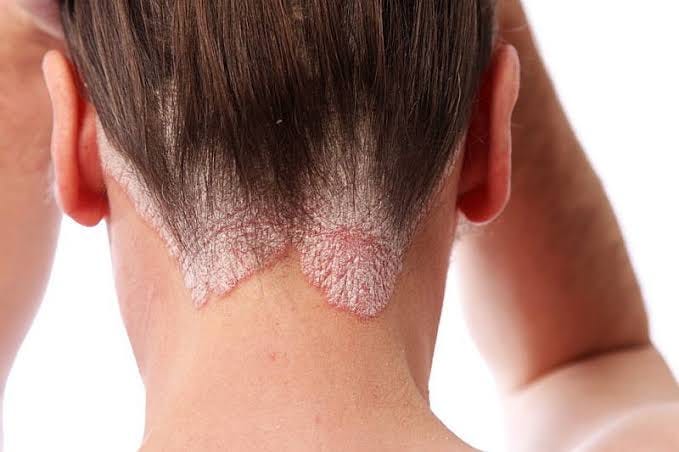 Protect Your Scalp: Recognizing and Managing Tinea Capitis