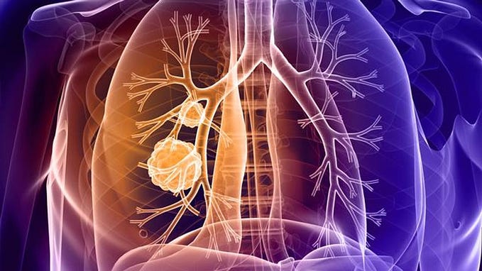 LUNG CANCER