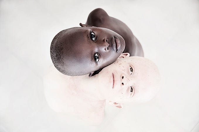 People with albinism: hunted for their body parts