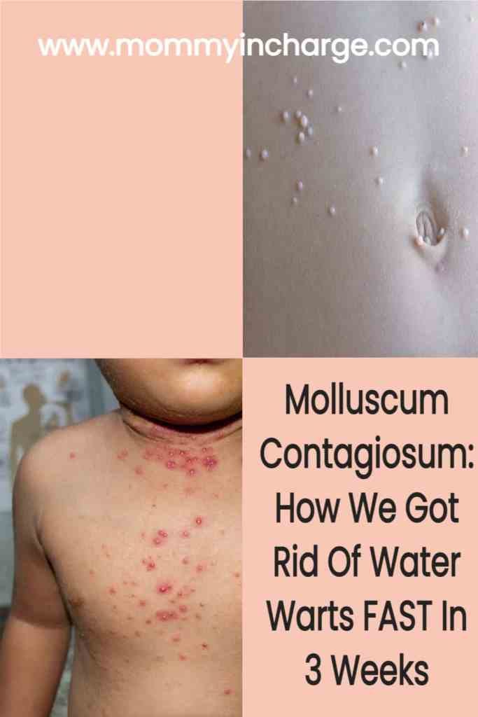 Where Can I Get Treated For Molluscum Contagiosum? by Molluscumaway