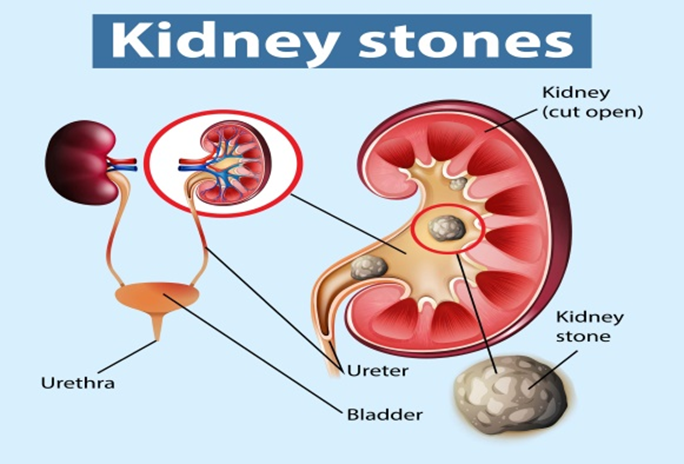 Kidney Stone Treatment in Pune: A Path to Pain-Free Living | by ...