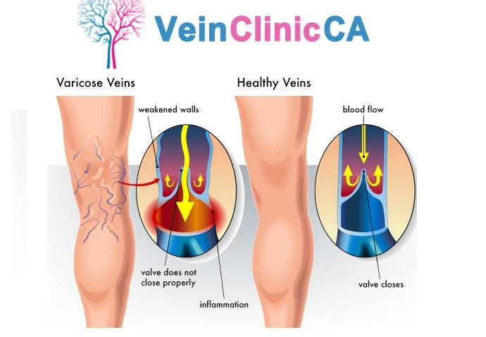 How to Treat Varicose Veins in Your 20s -  – Lounge Doctor