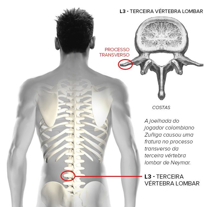 Neymar’s back injury, 2014.