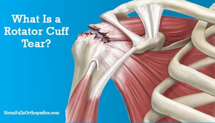 An Introduction to Rotator Cuff Tear, by Sioux Fall Orthopedics