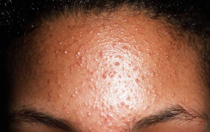 Malassezia folliculitis. Malassezia folliculitis, commonly known… | by  Victoria Essentials | Medium