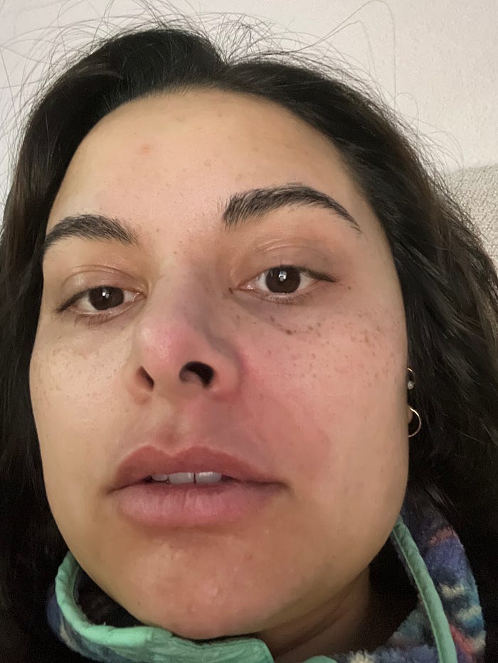 When an Antibiotic Changed My Life: My Experience With Ciprofloxacin Toxicity