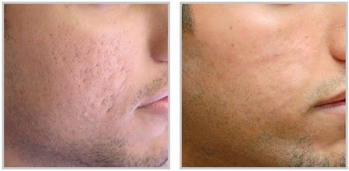 https://aestheticallysavy.com/prp-treatment-savannah-ga/