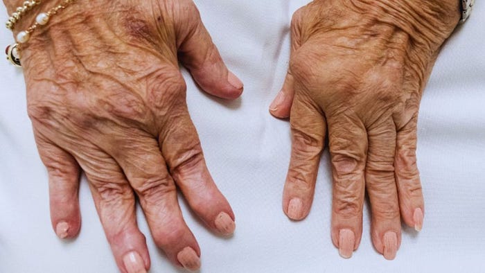 Close-up of elderly hands with joint swelling and visible deformities from rheumatoid arthritis, gently resting on white fabric. Wrinkled skin and curved fingers highlight stiffness and structural changes.