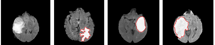 Python Tutorial Detecting a Brain Tumor with AI