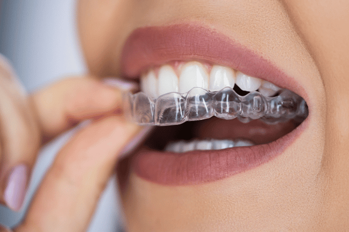 The Smile Revolution: Clear Aligners Transforming Orthodontic Treatment
