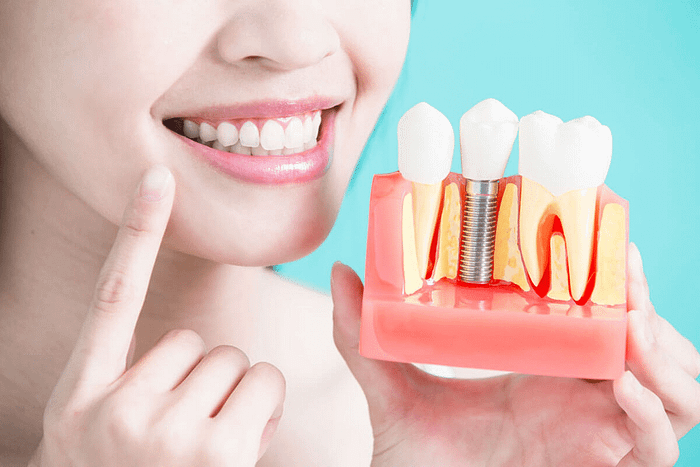 What To Look For Before Having A Dental Implant