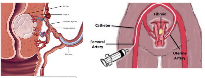 Uterine Artery Embolization Treatment Delhi