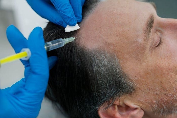 Scalp Micropigmentation for Men