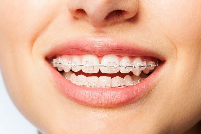 Achieving The Perfect Smile With A Beverly Hills Orthodontist