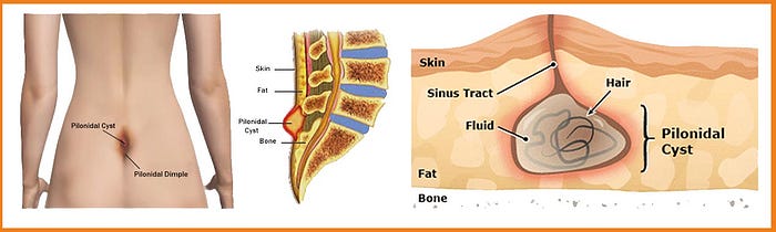 Endoscopic Pilonidal Sinus Treatment in Delhi