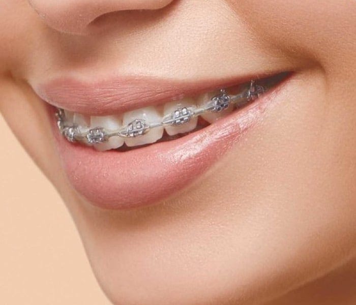 Braces Auckland Dentist Auckland Medium
