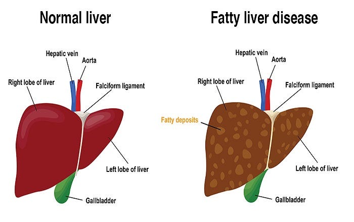 What are the symptoms of a fatty liver getting worse? | by Jonhovis ...