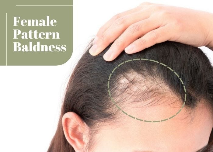 All You Need To Know About Female Pattern Baldness - Alchemane Hair ...