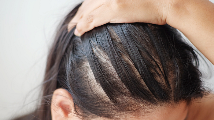 Hair Loss Treatment in Indirapuram