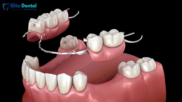 Removable Dentures in Bhubaneswar