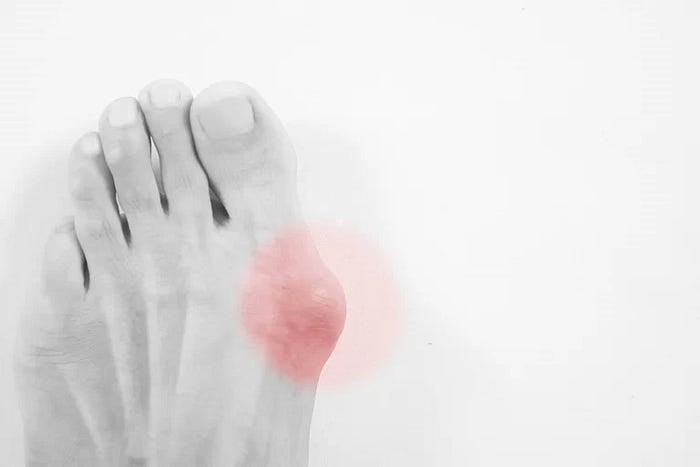 bunion pain relief (The Footwork Clinic)
