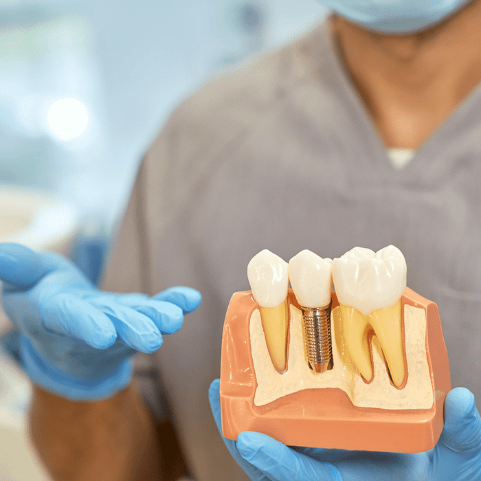 Recovering from a Dental Implant