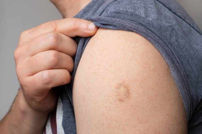 Transforming Raised Scars with Advanced Keloid Treatment