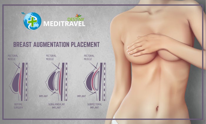 Breast Implant Placement. Breast Implant Placement under or over…, by  Destiny Meditravel