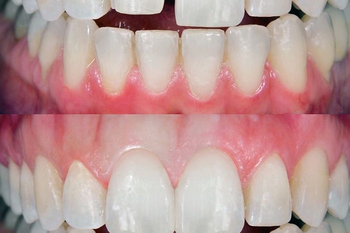 Dental Composite Bonding #SanAntonioDentist #SanAntonioCosmeticDentistry #SanAntonioDentalCare #DentistInSanAntonio #SanAntonioSmile #SanAntonioTeethWhitening #HernandezDentalSanAntonio #SanAntonioFamilyDentistry #SanAntonioOralHealth #SanAntonioImplants #SanAntonioChippedTeeth #SanAntonioVeneers #SanAntonioDentalClinic #SouthSanAntonioDentist #BestDentistSanAntonio #DentalCompositeBonding #CosmeticDentistry #SmileMakeover #DentalHealth #SanAntonioDentist #TeethWhitening #ChippedTeeth #HealthySm