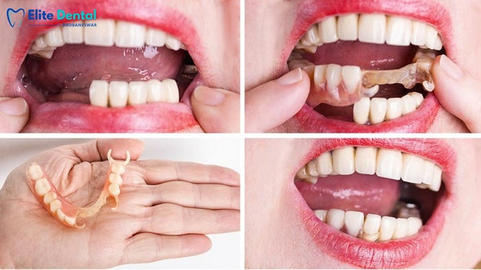 Removable Dentures — elitedentalbhubaneswar.com