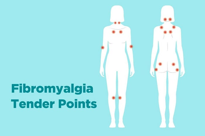 http://creakyjoints.org//wp-content/uploads/0819_Fibromyalgia_Tender_Points.jpg