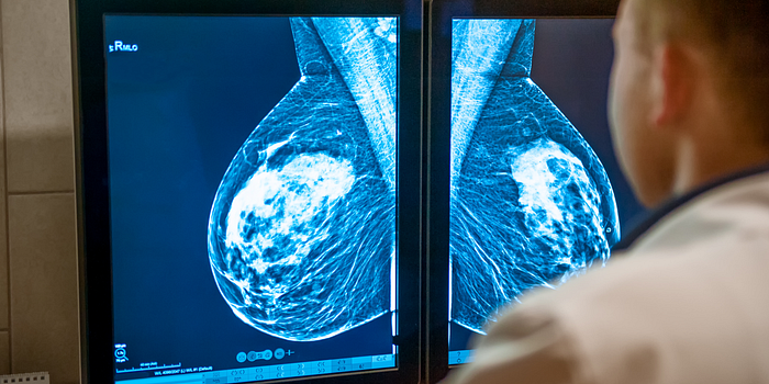 Mammography and Ultrasound Screening Matter at Prolife Diagnostics